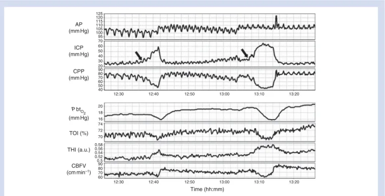 Fig 2 Two ICP-led events during a single recording from one patient (black arrows). An increase in ICP is the initiating factor and results in a decrease in CPP