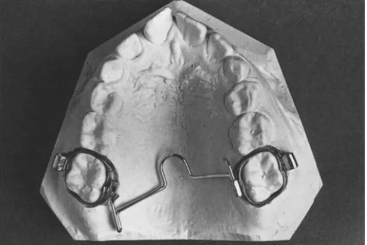 Figure 2 Position of the activated arch when inserted in one molar tube.