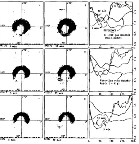 Figure 1 shows the original plots of a patient with a posterior to postero-septal MI 9 days old [Fig