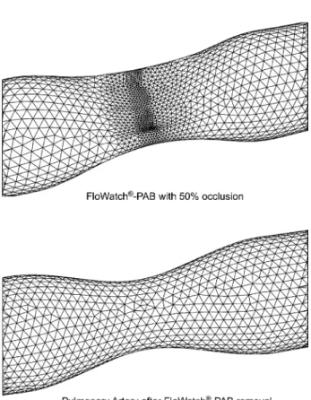 Fig. 1. The geometry of the computational model in the region of the banding with 50% occlusion of FloWatch 1 -PAB (top) and after FloWatch 1 -PAB removal (bottom)