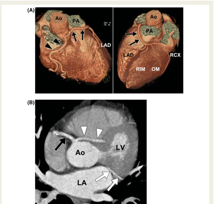 Figure 5 Imaging of coronary anomalies by multi-detector row computed tomography. (A) Three-dimensional multi-detector row computed tomography reconstruction of a right-sided single coronary artery with a pre-pulmonary course of the left main stem in a 42-