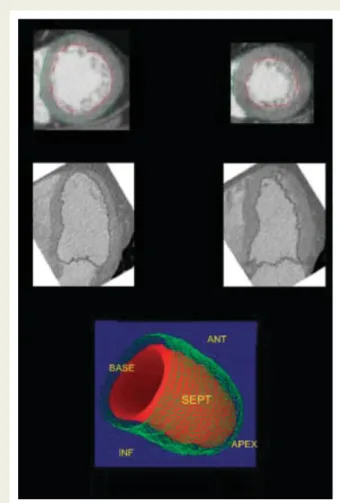 Figure 7 Assessment of left ventricular function and volumes by multi-detector row computed tomography