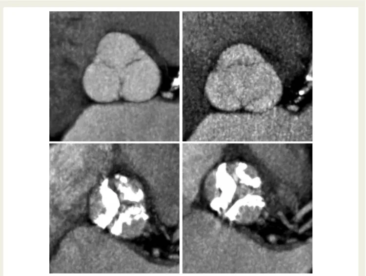 Figure 9 Assessment of valve disease by multi-detector row computed tomography. Aortic valve morphology assessed by computed tomo- tomo-graphy