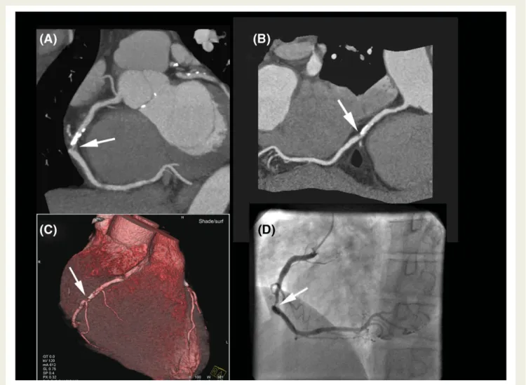 Figure 1 Coronary artery stenosis detection with multi-detector row computed tomography