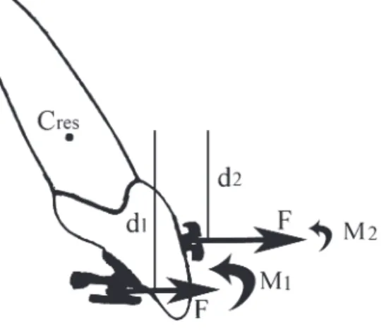 Table 3       Analysis of variance table for the effect of bracket type  on the generated moments in the sagittal plane on the displaced  lateral  incisor