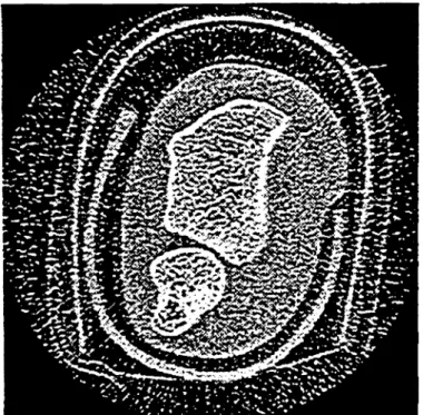 Figur 2: Ausschnitt einer globalen Tomographie- Tomographie-Aufnahme eines explantierten Radius links, gleiches