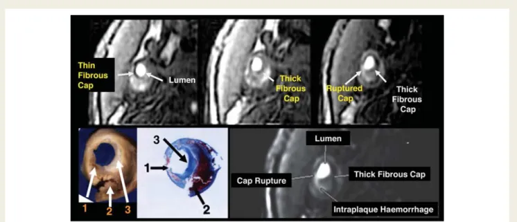 Figure 3 Magnetic resonance sequences normally used to perform angiography without the need of contrast agent (time-of-flight) allow the in vivo visualization of fibrous cap thickness and rupture in human atherosclerotic carotid plaque