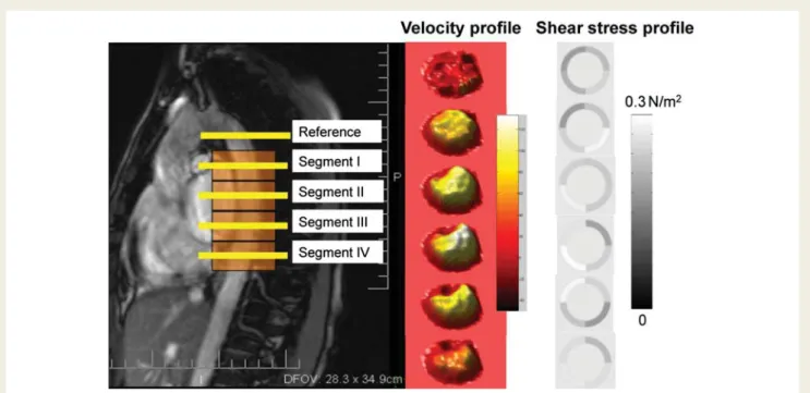 Figure 7 Velocity profiles at different levels of the descending aorta (left panel) can be measured by magnetic resonance imaging and used to derive shear stress