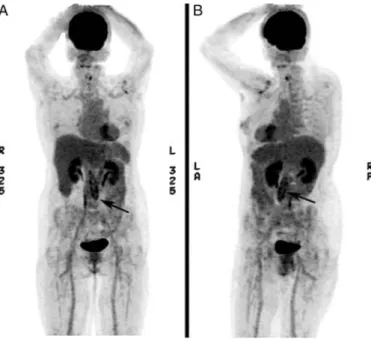Figure 1: FDG-PET – CT scan, 3-dimensional (3-D) reconstruction, shows elevated tissue activity in terms of regional glucose at the abdominal aorta