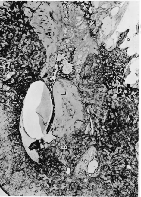 FIG. 5. Case IV. Mrs. N. With the exception of a small area (A) the whole capsule has undergone the otosclerotic process which at B breaks in the tympanic scala