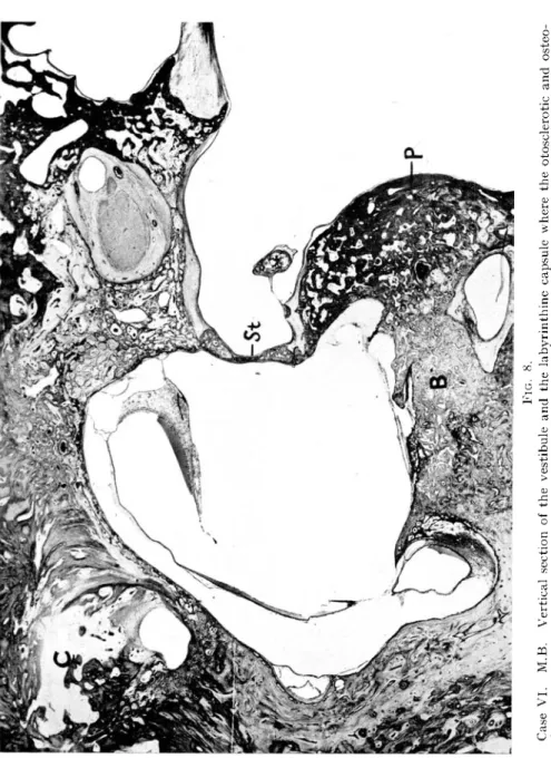 FIG. 8. Case VI. M.B. Vertical section of the vestibule and the labyrinthine capsule where the otosclerotic and osteo- dystrophic process are to be seen