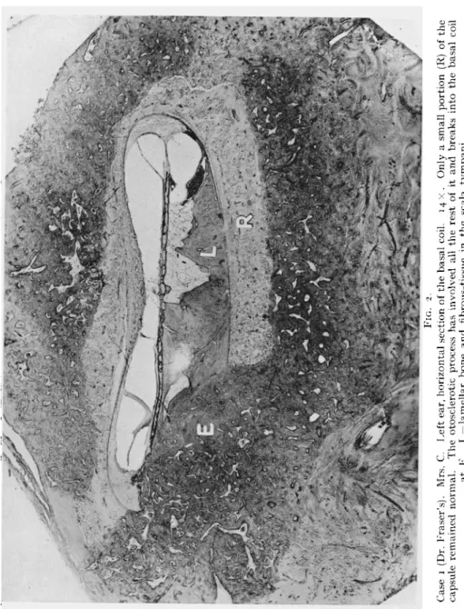 FIG. 2. Case i (Dr. Eraser's). Mrs. C. Left ear, horizontal section of the basal coil
