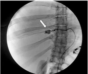 Fig. 2. Selective angiography demonstrating the intercostal aneurysm (arrow).