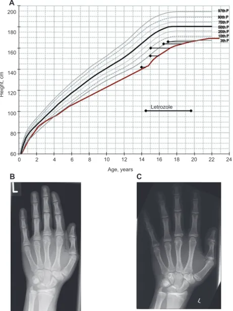 Figure 1     Growth chart (A) and X-ray pictures of the left hand (B, C) of a boy with ISS who was treated with letrozole (Femara, Novartis AG,  Switzerland) at a dose of 2.5 mg daily over a period of 5 years
