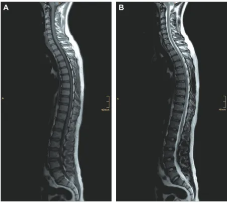 Figure 2     MR images of a 22.4-year-old man with ISS 3 years after the discontinuation of long-term letrozole treatment over 5 years