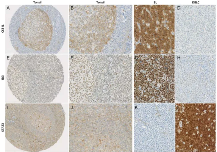 Figure 1. Results of immunohistochemical markers. ’CSE1L’ in reactive lymphoid tissue at (A) low (20×) and (B) high power (40×) magniﬁcation with predominant, cytoplasmic reactivity in germinal-center dark cells and less strong in the light zone, but not i