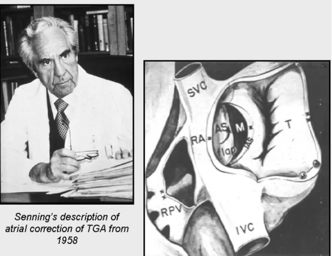 Fig. 6. Senning’s description of atrial correction of TGA from 1958.