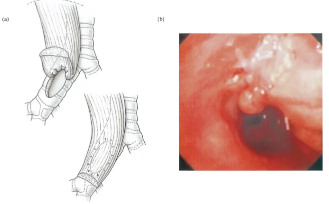 Fig. 1. Intrathoracic SA muscle transfer for the treatment of bronchial stump ®stula following upper lobe resection in order to avoid completion pneumo- pneumo-nectomy in a patient with poor cardiac function