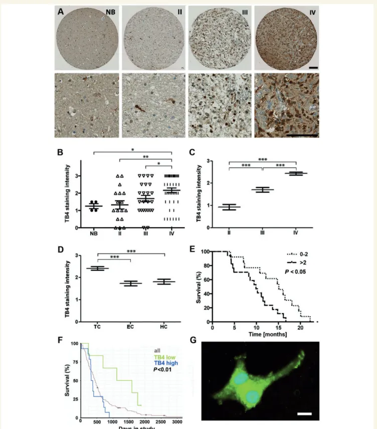 Figure 1 TB4 is overexpressed in high-grade gliomas and low TB4 expression correlates with better outcome