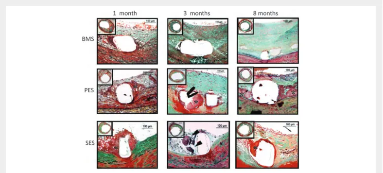 Figure 6 Delayed arterial healing following DES vs. BMS implantation. Time course of arterial healing in BMS, paclitaxel-eluting stents (PES: Taxus DES), and sirolimus-eluting stents (SES: Cypher DES) from 1 to 8 months after stent implantation