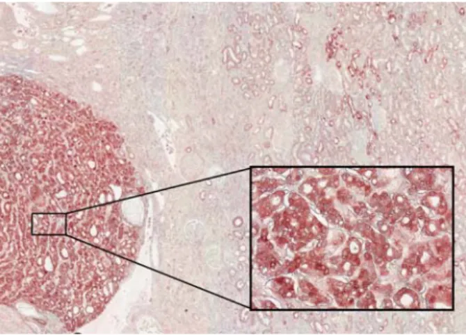 Fig. 3. PV as a marker of chromophobe RCC. Immunohistochemical analysis reveals a strong and ubiquitous expression of PV in a chromophobe renal carcinoma (Inset, illustrating the intense staining in chromophobe cancer cells), and staining of the early DCT 