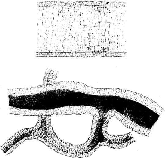Figure 2 First description of wall thickening of small arteries in hypertension. These drawings are taken from the 1868 paper by George Johnson