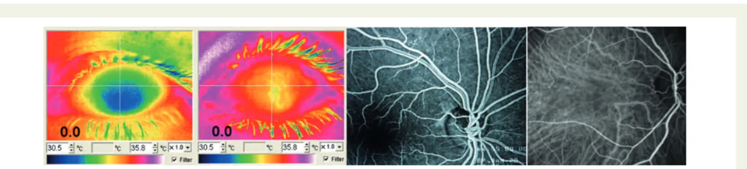 Figure 5 Classical ocular blood flow dysfunctions: (i) Anterior ischaemic neuropathy. (ii) Central retinal arterial occlusion