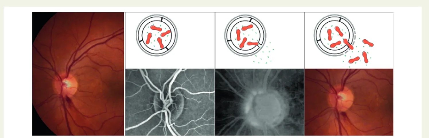 Figure 9 Pathogenesis of optic disc splinter haemorrhages: Under normal conditions, the vessels in and around the optic nerve head are watertight