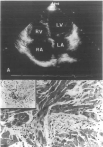 Figure 1 (A) Doppler-eehocardio- Doppler-eehocardio-graphic recording at the four chamber apical view showing slightly  dimin-ished left ventricular systolic function and dilatation of the right cavities, particularly of the right atrium