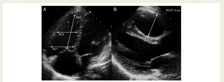 Figure 1 Measurement of right ventricular (RV) dimensions using echocardiography. Two-dimensional measurements should be made in dif- dif-ferent parts of the RV
