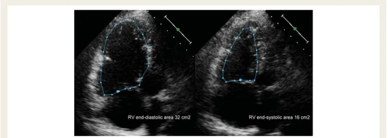 Figure 2 Measurement of fractional area change (FAC). Right ventricular end-diastolic and end-systolic area is measured from an apical four- four-chamber view