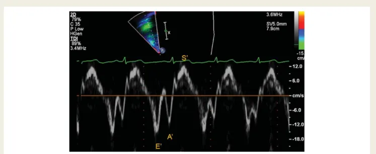Figure 4 Pulsed tissue Doppler of the tricuspid annulus. This a pulsed Doppler tracing obtained in the tricuspid annulus from the apical four- four-chamber view