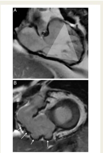 Figure 8 The triangle of dysplasia in arrhythmogenic right ven- ven-tricular (RV) cardiomyopathyopathy (ARVC)