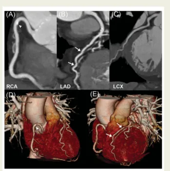 Figure 2 Dual-source computed tomography coronary angio- angio-graphy in a 67-year-old woman with tachycardia and atypical chest pain
