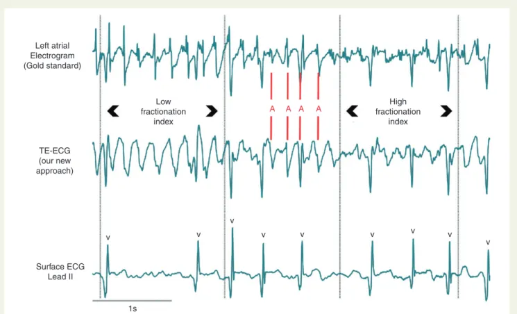 Figure 3 demonstrates the excellent match between frequency and complexity of the atrial activation in the atrium (LA, gold standard) and the TE-ECG