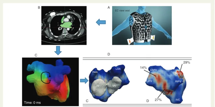 Figure 4 Vest carrying 252 electrodes placed on the patient’s chest (A) during CT scan (B) to reconstruct cardiac activation which is then analysed with a phase mapping algorithm (C )