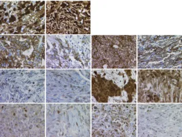 Fig. 1. Examples of EMT protein marker expression in a patient each with epithelioid (left panel) and sarcomatoid (right panel) mesothelioma,  respec-tively (magnification 400): (A) tumour and stroma cells showing a variable expression of periostin in both