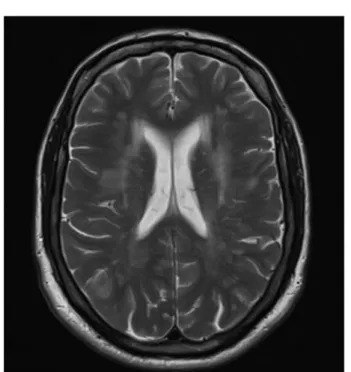 Figure 2. Magnetic resonance imaging showing confluent T2-hyperintense signal changes.