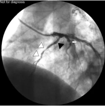 Fig 4 Postoperative coronary angiography showing complete occlusion of the left anterior descending coronary artery stent (black triangle) (60%