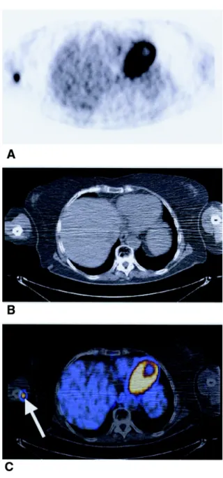 Figure 1. Maximum intensity projection PET image showing a  contiguous lesion along the plexus brachialis and the vessel-nerve bundle  of the right arm