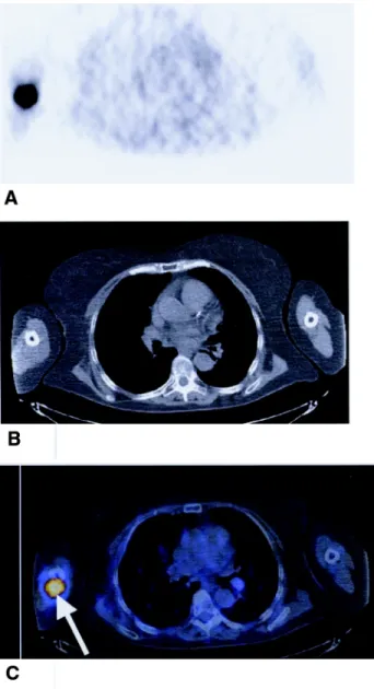 Figure 3. Maximum intensity projection PET image from the follow-up  examination, revealing an extensive increase in the tumor burden in the  right arm and new lesions in the left side.
