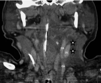 Figure 3: A CT scan showing downward spread of retropharyngeal abscess formation (arrow).