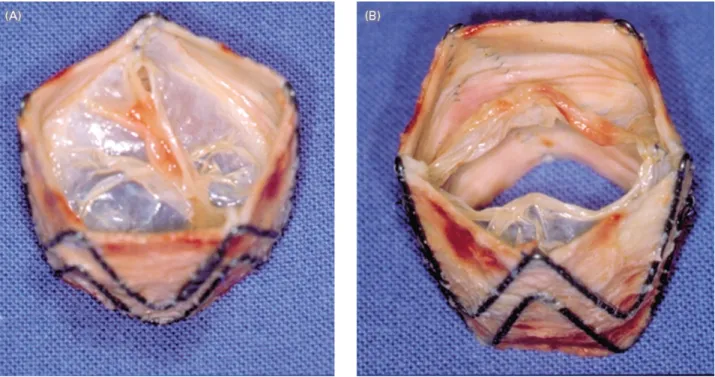 Fig. 5. Post-mortem examination with the explanted valve in open (A); and closed (B) position, excluding any valve deformation or thrombus.