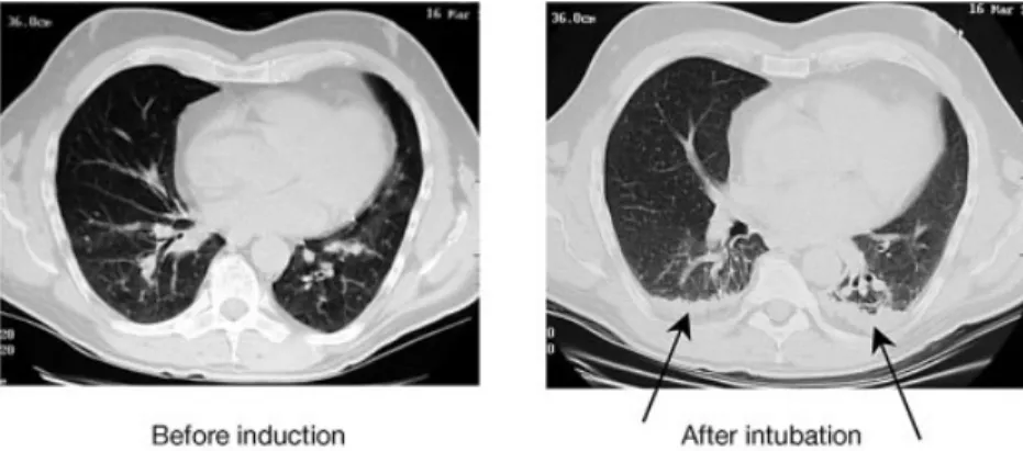 Fig 2 Two-dimensional representation of a volume image from an anaesthetized subject. The surface of the lung is shown in shades of grey and atelectasis is shown in white