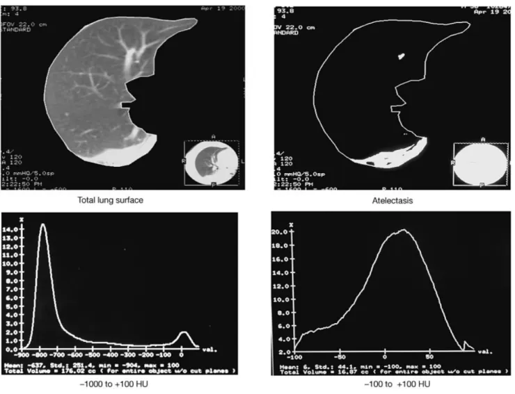 Fig 3 Measurement of atelectatic surface by CT of the lung at the level of the interventricular septum and corresponding histograms