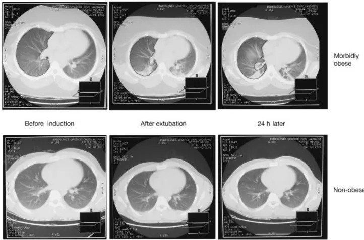 Fig 6 Samples of CT scans of a morbidly obese and a non-obese patient before anaesthesia, after extubation and 24 h later
