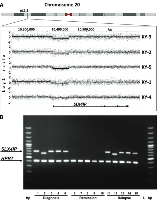 Figure 1. Deletion of the first two exons of SLX4IP on chromosome 20 in five ETV6/RUNX1-negative ALL samples