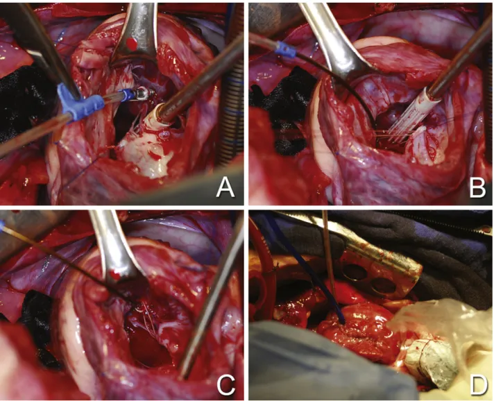Fig. 3. Intraoperative view of the implant of the V-Chordal system. A: The V-Chordal device is implanted with a sutureless procedure in the tip of the papillary muscle using the self-fixating helical element, activated by the handle