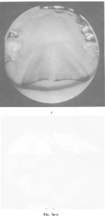 FIG.  3a-c Monomorphic adenoma of palate: