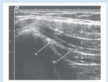 Fig 1 Ultrasound image of the IL and IH nerves between the in- in-ternal oblique and transverse abdominal muscles, 5 cm cranial and slightly lateral to the anterior superior iliac spine